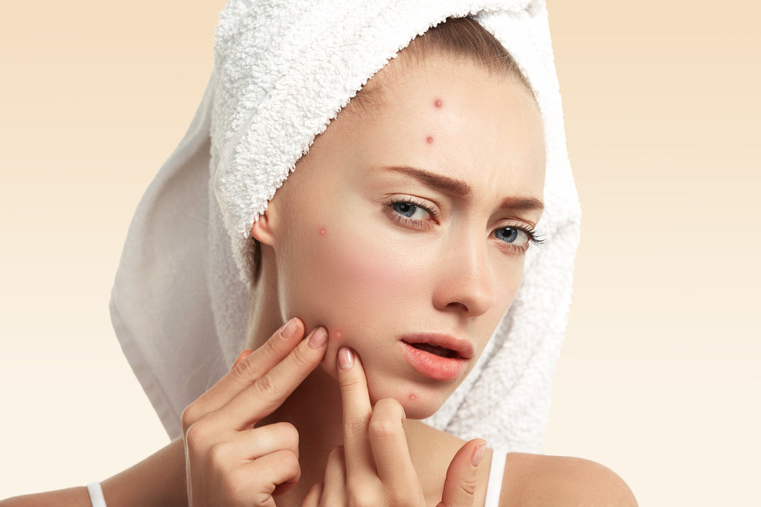 Is Sea Moss Good For Acne? The Truth About This Ocean Remedy
